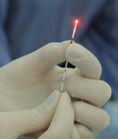 tratamento de varizes a laser em Curitiba