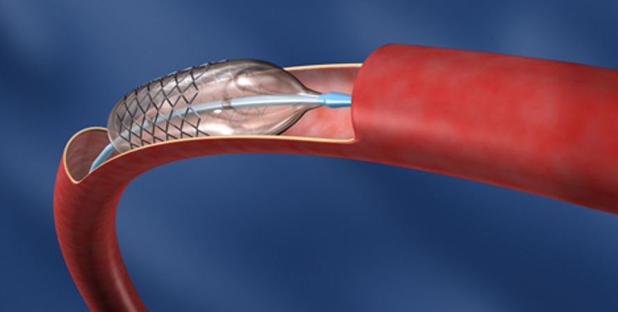 Cirurgia endovascular em Curitiba Clínica Angioprime